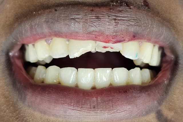 dental abscess treatment liverpool