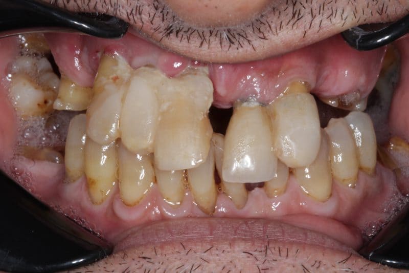 Before single tooth implant